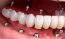  کاشت دندان چیست؟